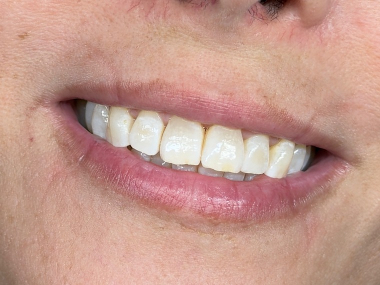 Teeth Whitening
